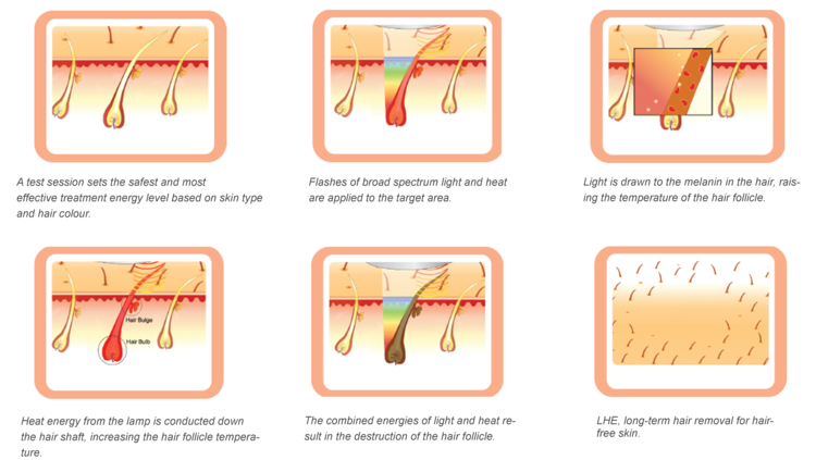 Laser_Hair_Removal.png