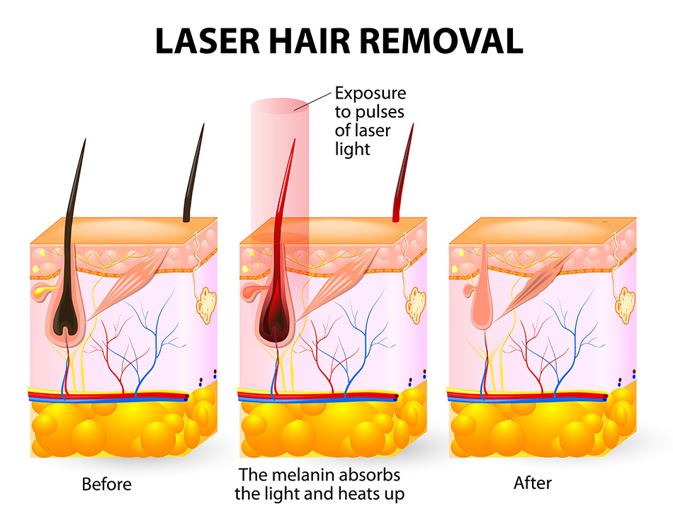 laser hair removal principle.png laser hair removal principle.png